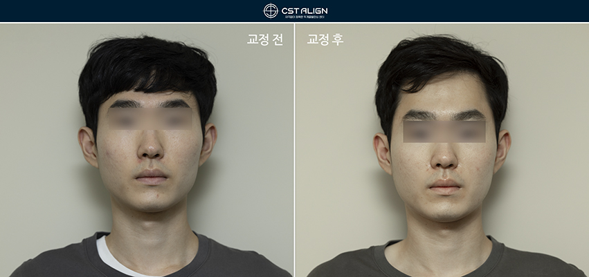 전후사진